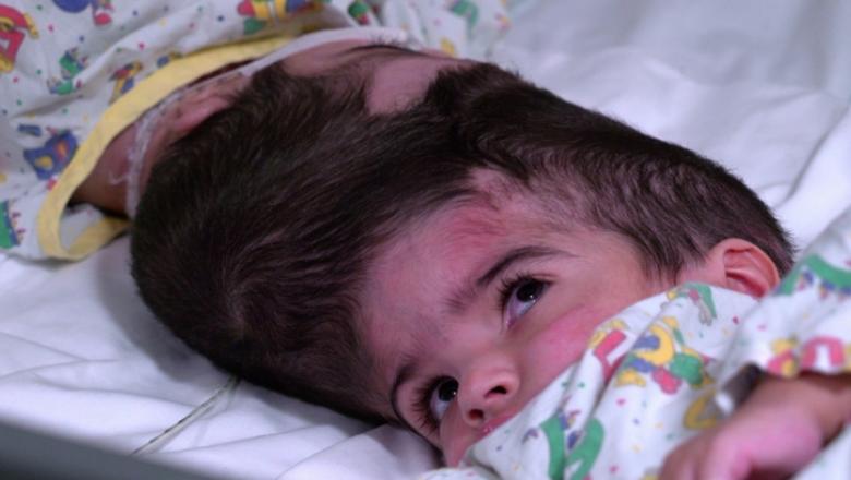 Operație maraton. Două siameze cu craniile unite au fost separate