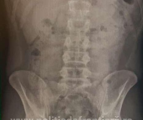 Un ucrainean, prins cu droguri de mare risc ascunse în stomac