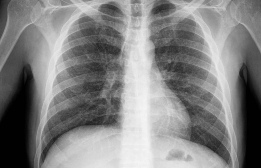 Alarmant: o boală rară de plămâni, mortală, nu e corect diagnosticată