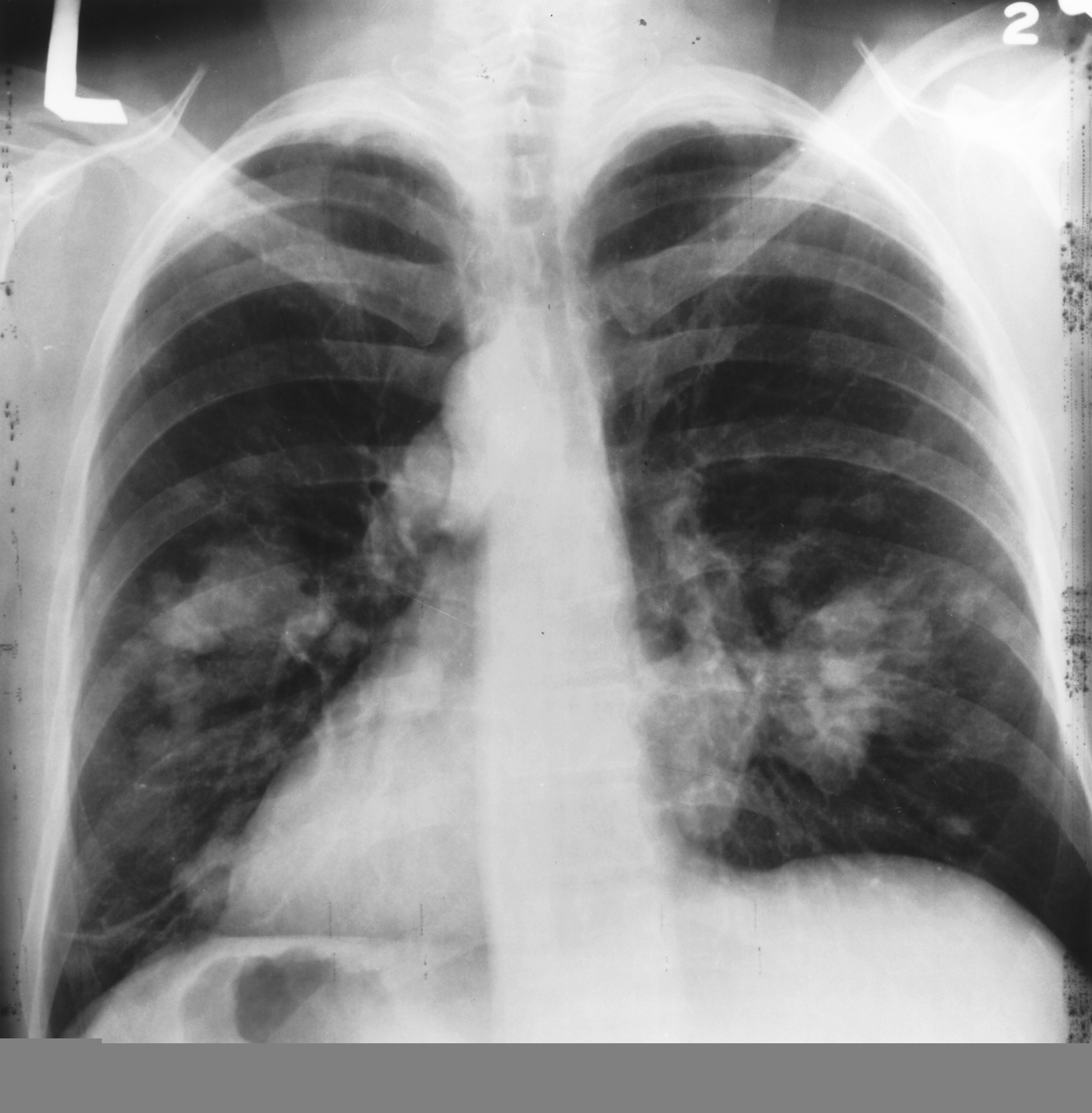 Ziua Mondială de Luptă împotriva Cancerului Pulmonar. Peste 10.000 de români își pierd viața anual din cauza acestei afecțiuni