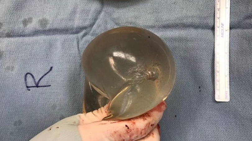 Silicoanele au salvat-o de la moarte! Medicii au fost șocați când au văzut