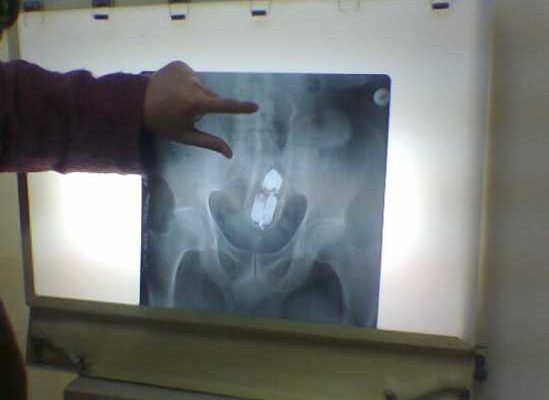 S-a ”jucat” cu iubita lui și a ajuns la urgențe! Medicii au fost șocați să vadă ce are