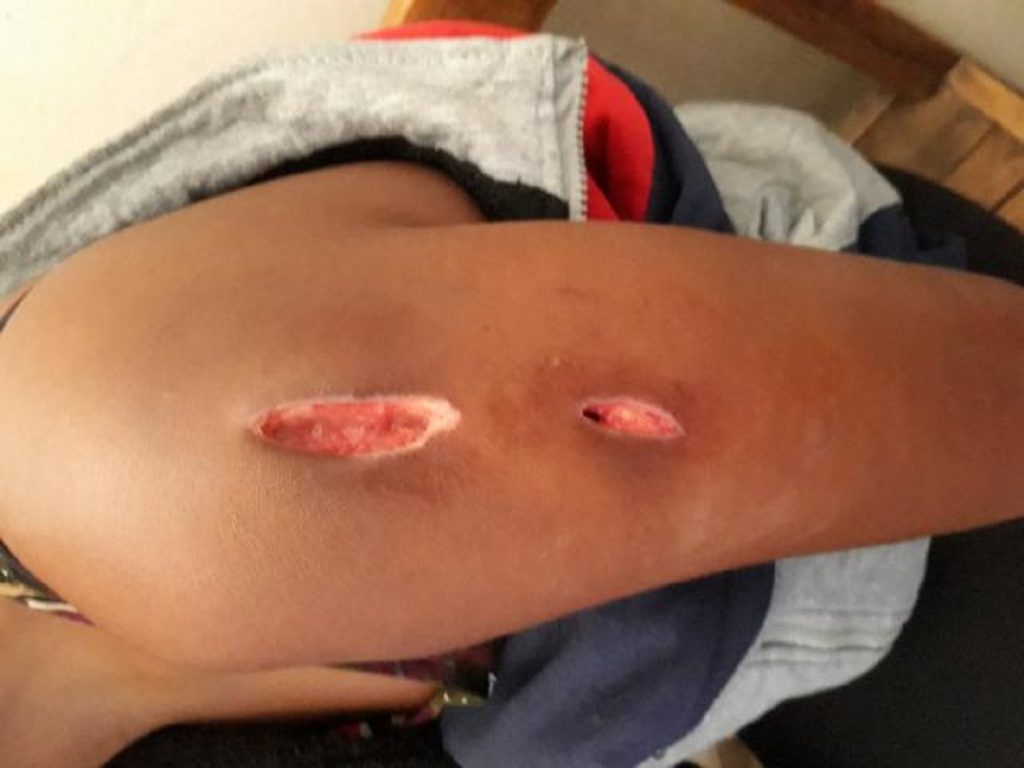 Australia, sub teroarea creșterii numărului de infectări cu ulcer Buruli. „Un virus care consumă carne umană”