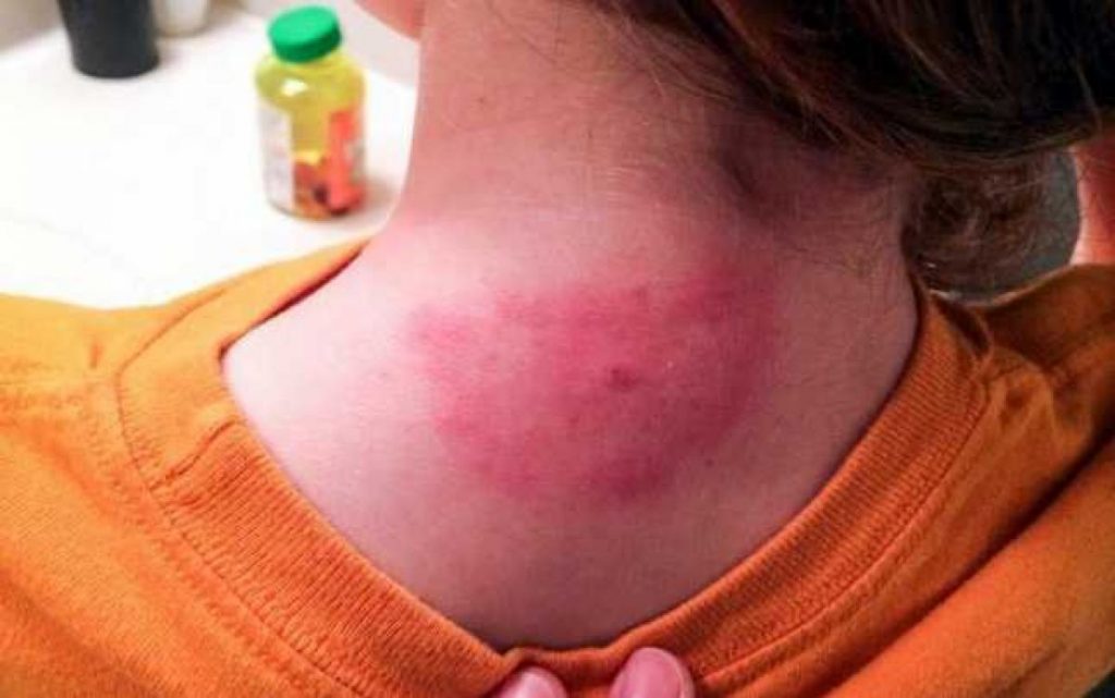 A început invazia de țânțari și căpușe în București. Zeci de copii la spital, dar Primăria nu face nimic pentru rezolvarea situației