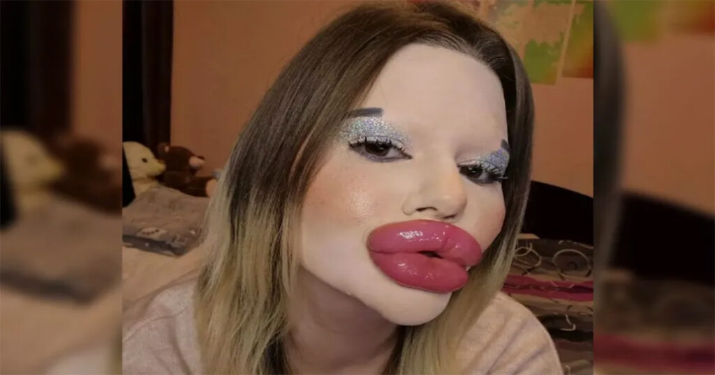 Femeia cu „cele mai mari buze din lume” suferă din dragoste. Toți bărbații fug de ea