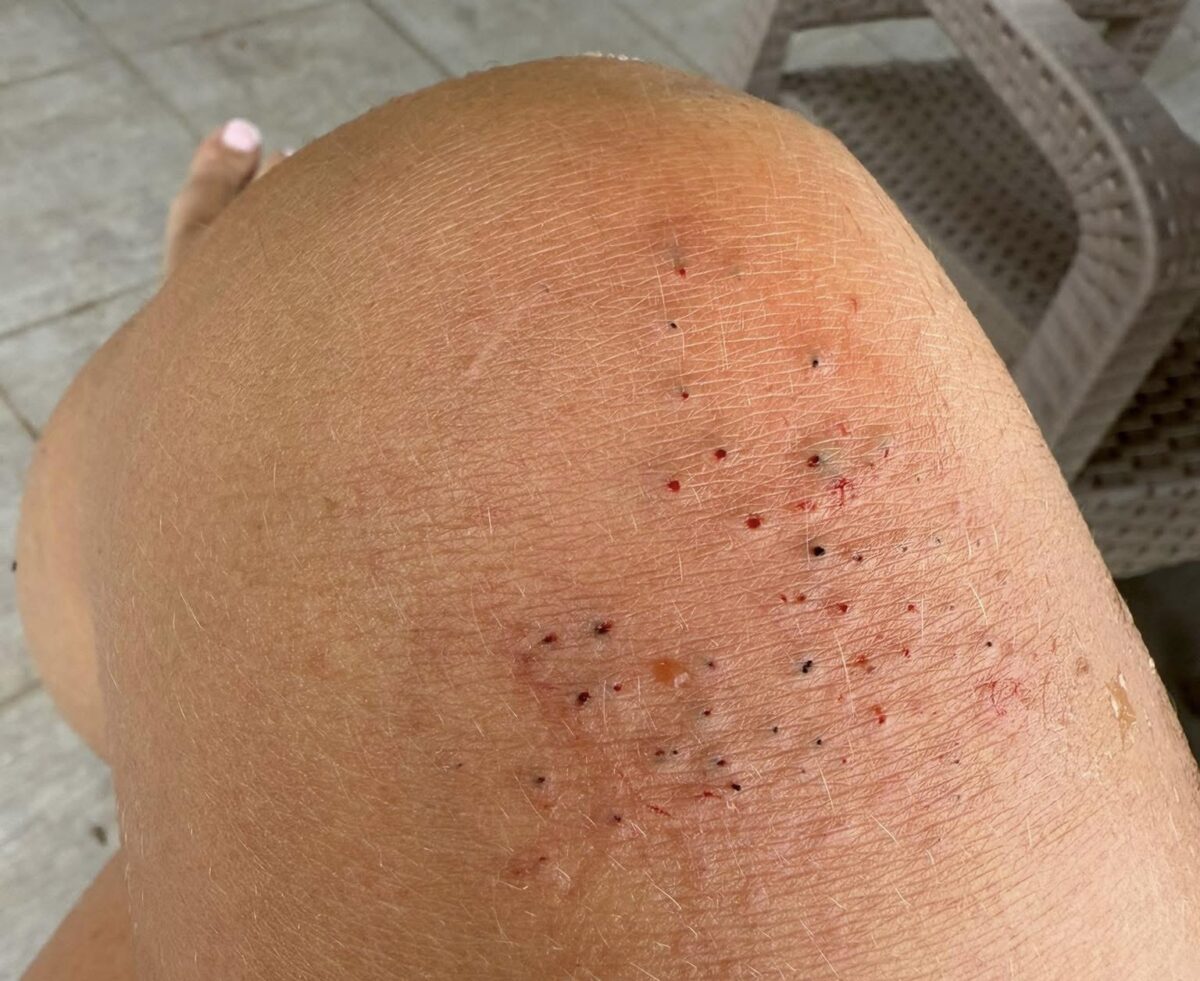 Ce trebuie să faci dacă ai fost înțepat de un arici de mare în Grecia