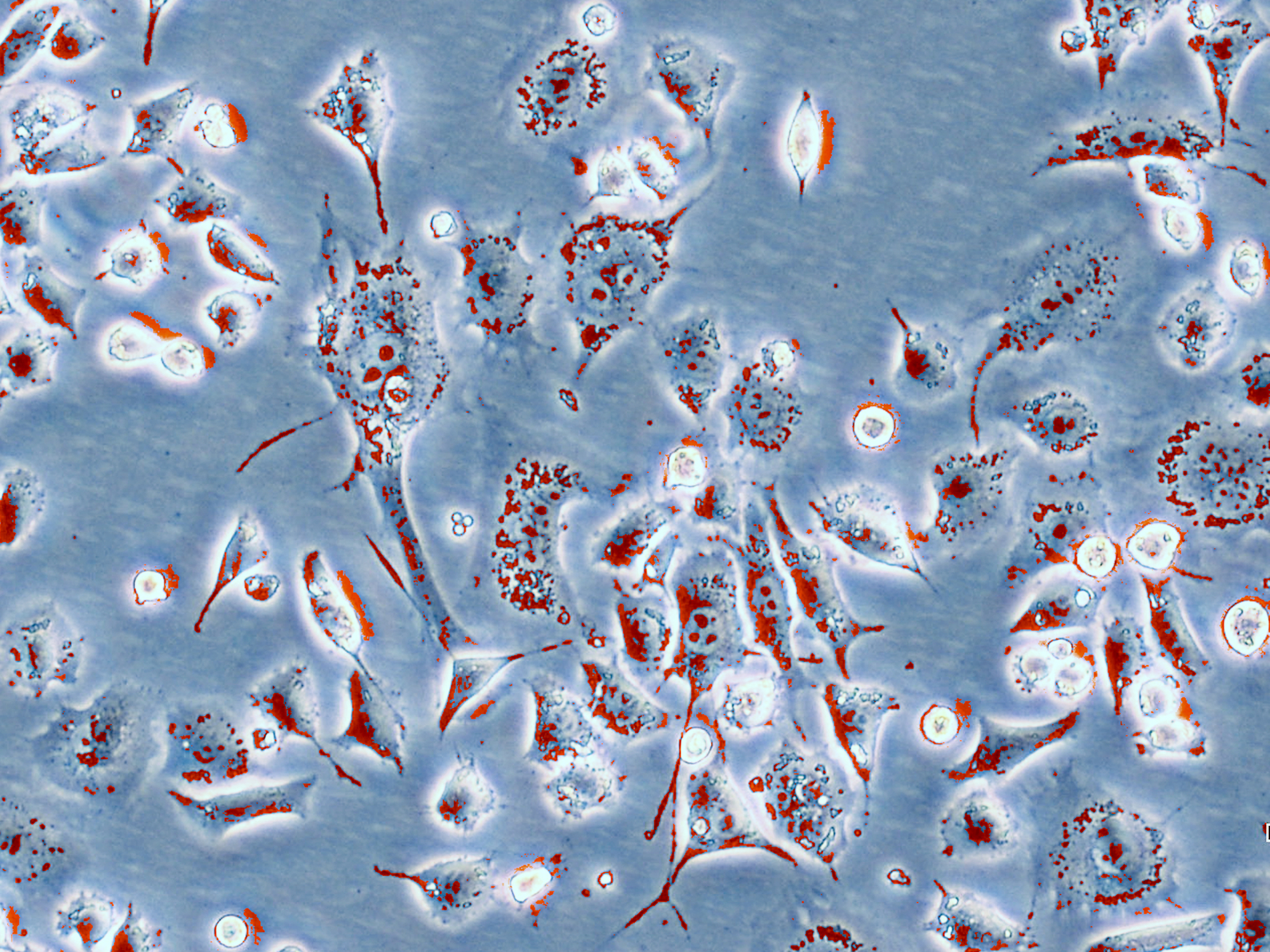 celule cancer