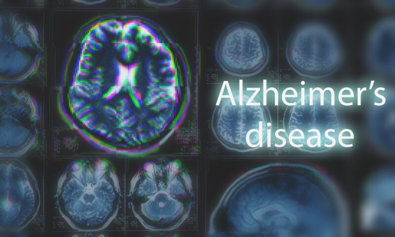 Diagnosticul demenței, revoluționat de AI. Descoperirea care schimbă tratamentul pentru Alzheimer