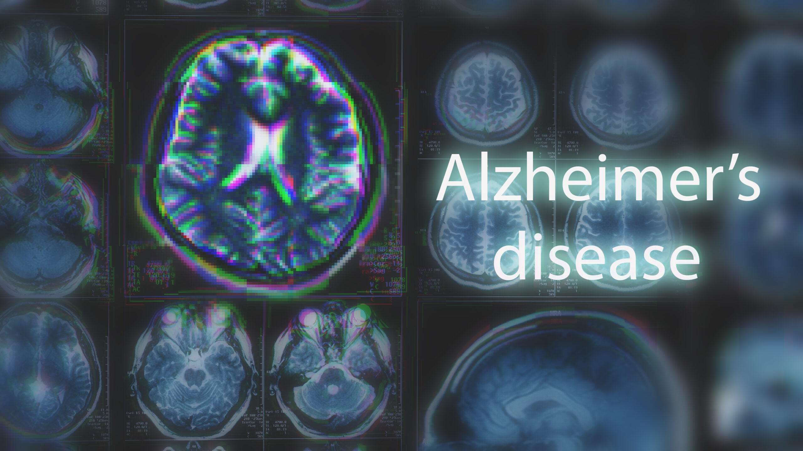 Diagnosticul demenței, revoluționat de AI. Descoperirea care schimbă tratamentul pentru Alzheimer