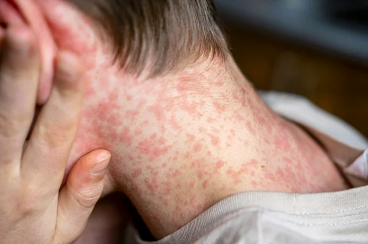 Alertă globală de rujeolă. Panică pe aeroporturile americane. România rămâne epicentrul epidemiei în Europa