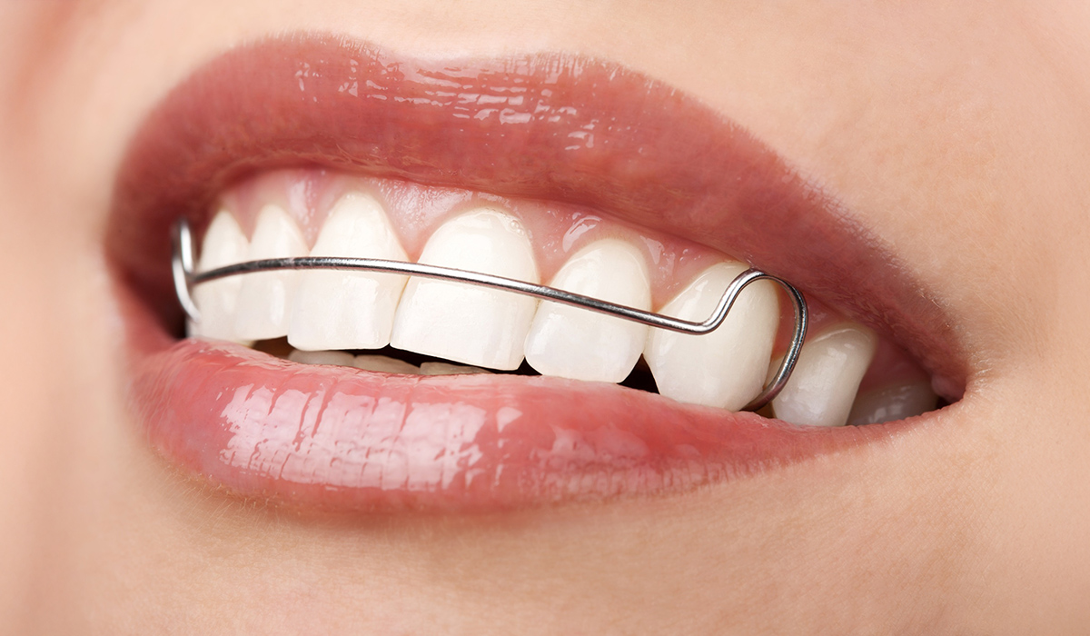 Retainerul dentar: menținerea rezultatelor obținute cu aparatul dentar