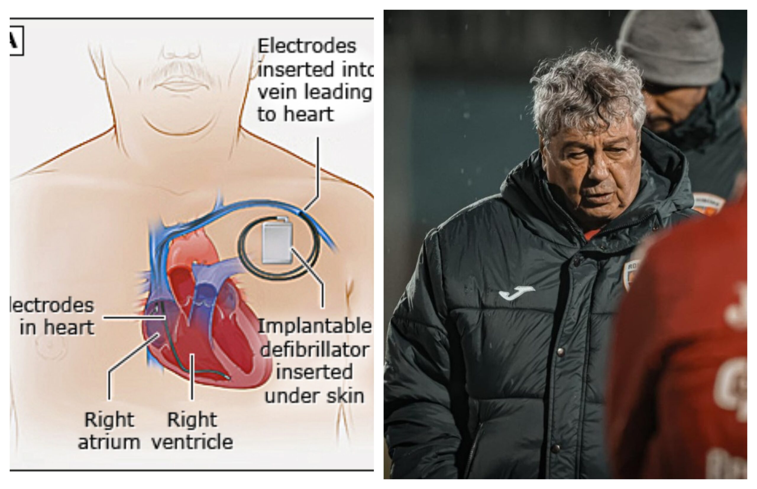 Ce este și cum funcționează defibrilatorul cardiac intern, dispozitivul care i-a fost implantat lui Mircea Lucescu