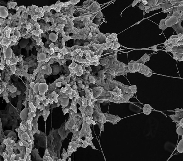 Celule canceroase