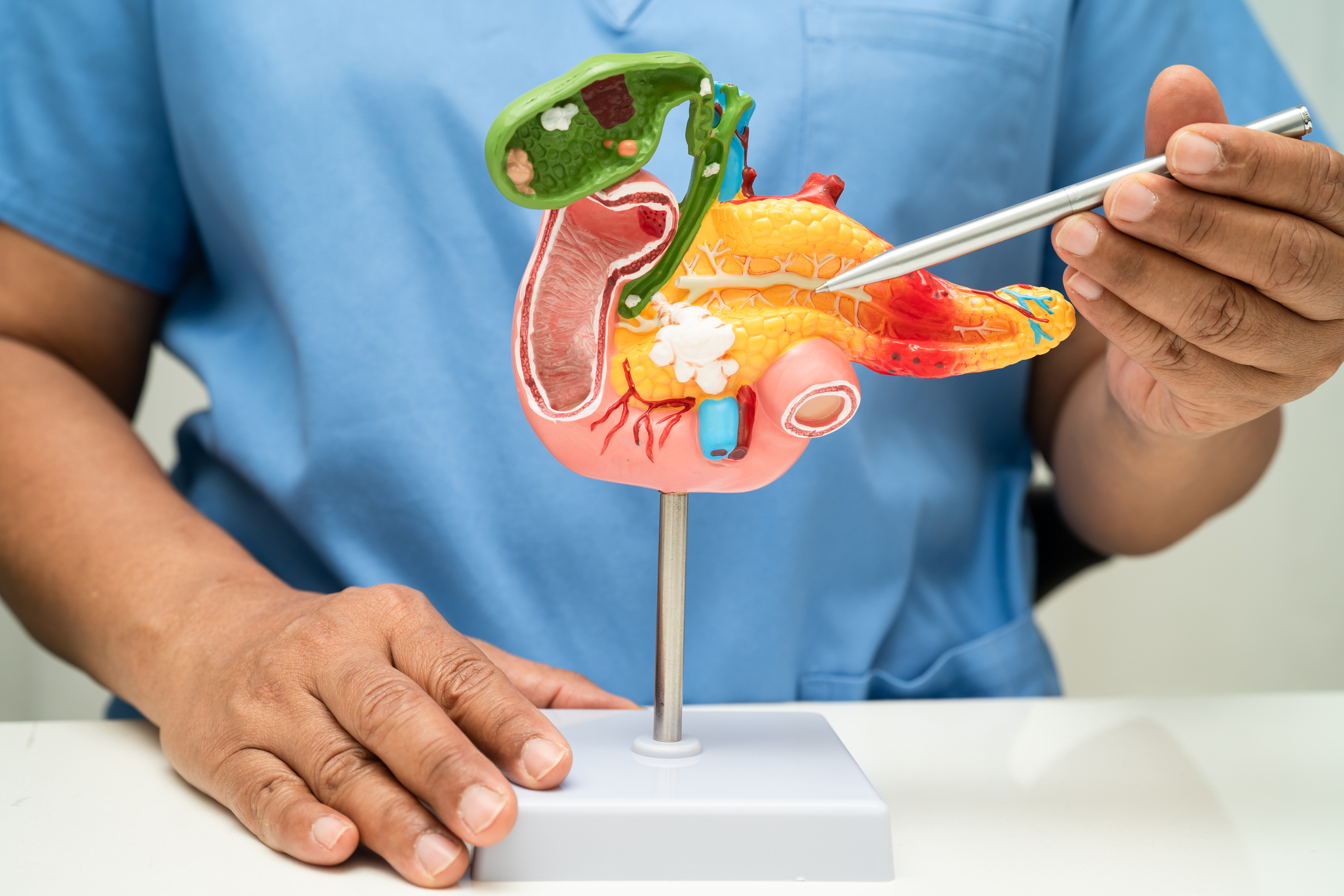Pastila care schimbă tratamentul cancerului pancreatic. Supraviețuirea s-a dublat într-un studiu cu 500 de pacienți