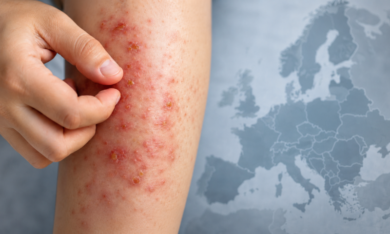 O infecție rară se extinde în Europa. „Boala ploii” poate semăna cu alte afecțiuni